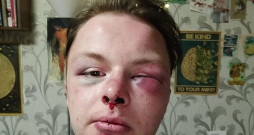 Cietušajam Līvajam Amareinam pēc uzbrukuma tika konstatēti galvas mīksto audu sasitumi, lauzts deguns, pietūkums abās sejas pusēs, kā arī ir bojāta dzirde vienā ausī.