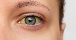 Dzelte var signalizēt par dažādām hroniskām vai akūtām slimībām. Dzelte var signalizēt par dažādām hroniskām vai akūtām slimībām.