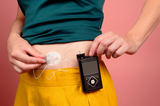  I tipa diabēta pacientu dzīves kvalitāti nosaka insulīna terapija mūža garumā.