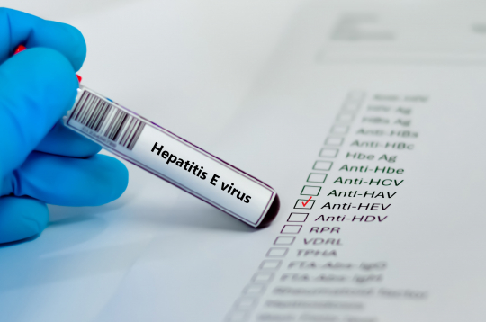 Kā radies vīrusa hepatīts E?