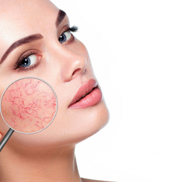 Kuperozu sejas ādu jeb kuperozi raksturo paplašināti asinsvadi, kas tuvu ādas virskārtai un ir izteikti reaģējoši. 