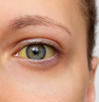 Dzelte var signalizēt par dažādām hroniskām vai akūtām slimībām.