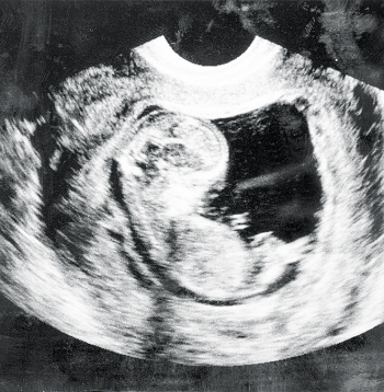 Cilvēka embrijs. Cilvēka embrijs.