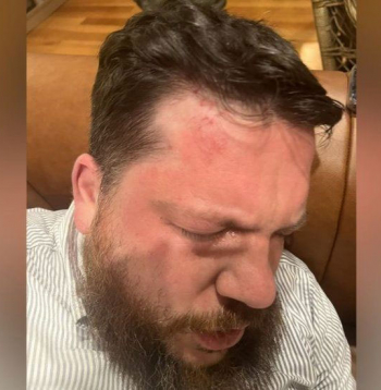 Leonīds Volkovs pēc uzbrukuma.