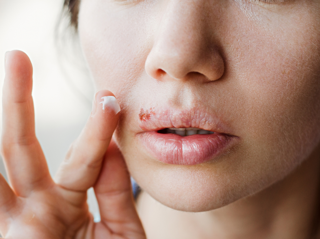 Herpes vīruss ir pastāvīgs organisma iemītnieks, kas par sevi atgādina tam labvēlīgos apstākļos.