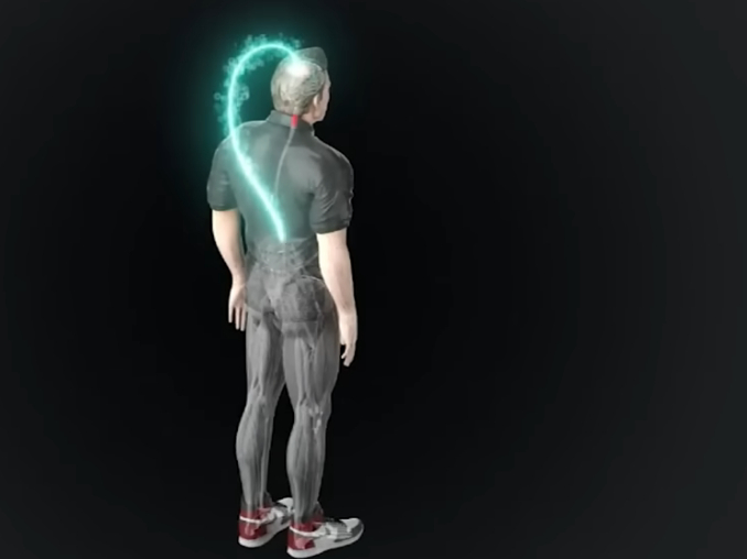 "Neuralink" ievietojis implantu cilvēka smadzenēs.