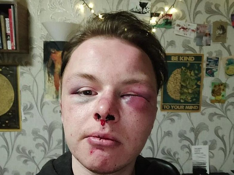 Cietušajam Līvajam Amareinam pēc uzbrukuma tika konstatēti galvas mīksto audu sasitumi, lauzts deguns, pietūkums abās sejas pusēs, kā arī ir bojāta dzirde vienā ausī.
