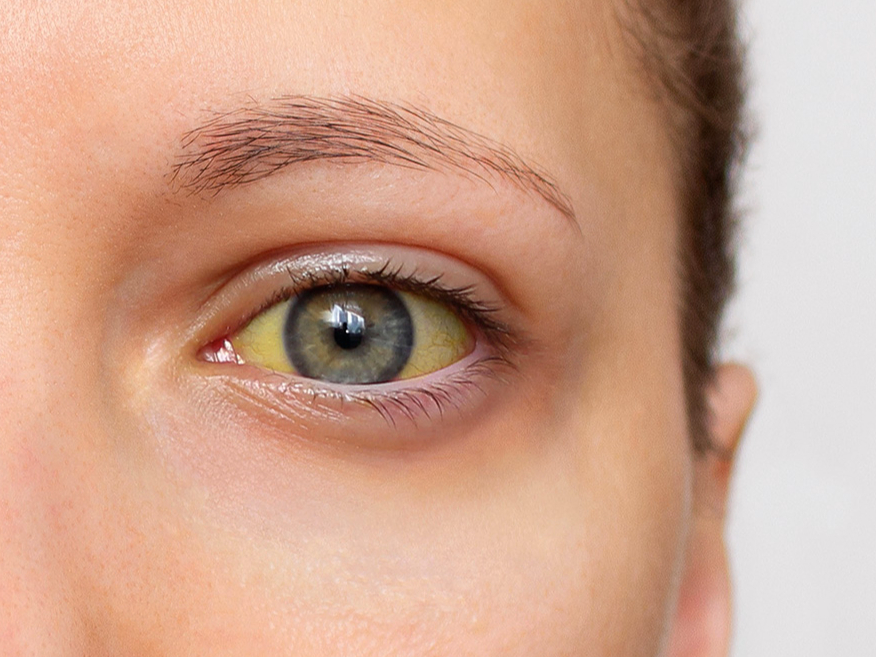 Dzelte var signalizēt par dažādām hroniskām vai akūtām slimībām.