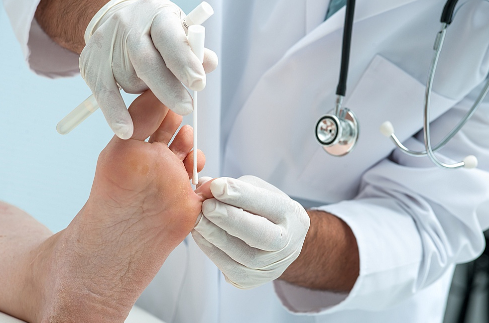 Paraugu sēnīšu infekcijas diagnostikai noņems dermatologs vai podologs.