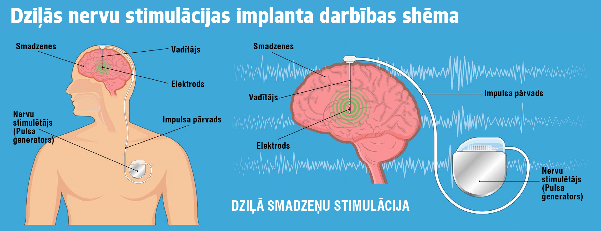 Dziļās nervu stimulācijas implanta darbības shēma.