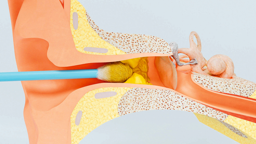 Ļoti bieži ar vates kociņiem sērs tiek sastumts auss ārējās ejas dziļumā, veicinot korķa izveidošanos.