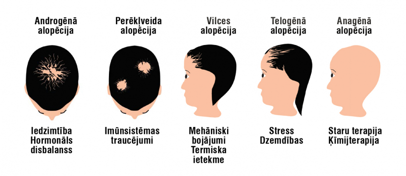 Alopēcijas veidi.